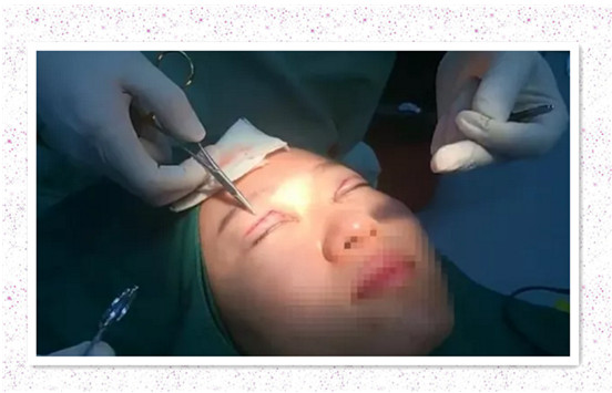 開內(nèi)眼角要多久恢復(fù) 依個人體質(zhì)而定 開內(nèi)眼角要多久恢復(fù) 依個人體質(zhì)而定