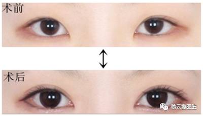 開內眼角要多少錢 各地區(qū)不統(tǒng)一