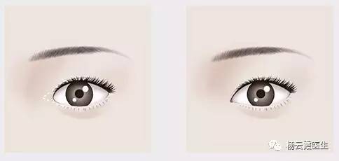 開內眼角要多少錢 各地區(qū)不統(tǒng)一