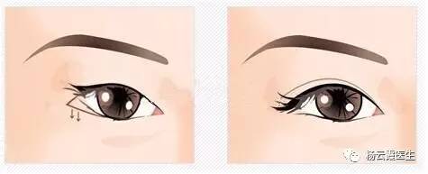 開內眼角要多少錢 各地區(qū)不統(tǒng)一