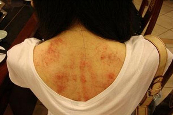 刮痧可以去火嗎 刮痧祛火方法 刮痧可以去火嗎 刮痧祛火方法