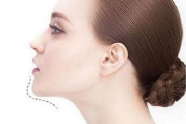 墊下巴多久可以恢復 墊下巴后多久可以吃飯 墊下巴多久可以恢復 墊下巴后多久可以吃飯