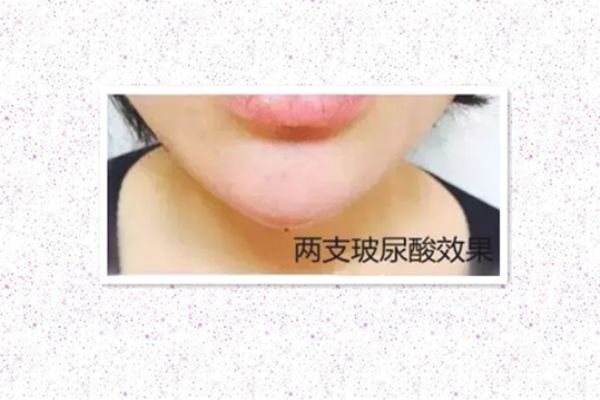 玻尿酸打下巴怎么打的 玻尿酸打下巴是什么感覺 玻尿酸打下巴怎么打的 玻尿酸打下巴是什么感覺