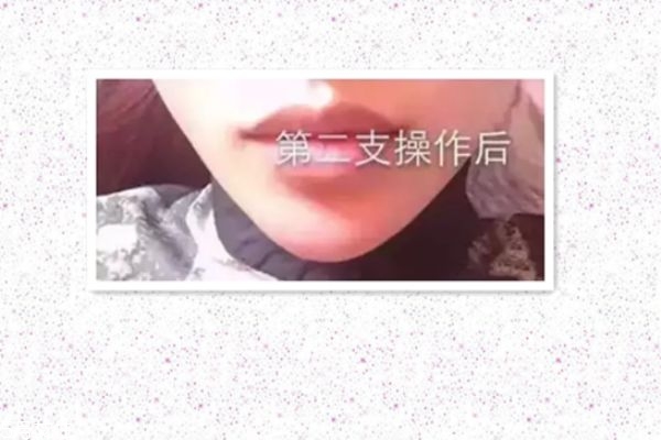 玻尿酸打下巴怎么打的 玻尿酸打下巴是什么感覺 玻尿酸打下巴怎么打的 玻尿酸打下巴是什么感覺