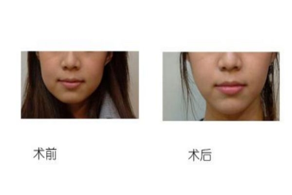 墊下巴前后對(duì)比照片 墊下巴的優(yōu)缺點(diǎn)