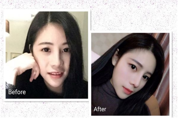 鼻翼縮小手術前后對比照片 縮鼻孔手術對比照片 鼻翼縮小手術前后對比照片 縮鼻孔手術對比照片