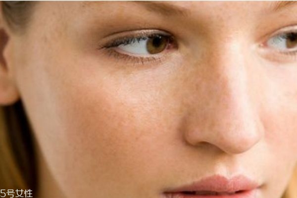 黃褐斑怎么內(nèi)調(diào) 黃褐斑治療方法 黃褐斑怎么內(nèi)調(diào) 黃褐斑治療方法