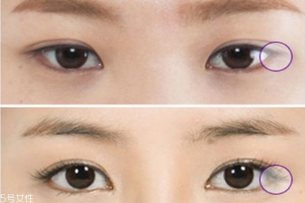 眼瞼下至術(shù)是什么 眼瞼下至術(shù)的手術(shù)原理 眼瞼下至術(shù)是什么 眼瞼下至術(shù)的手術(shù)原理