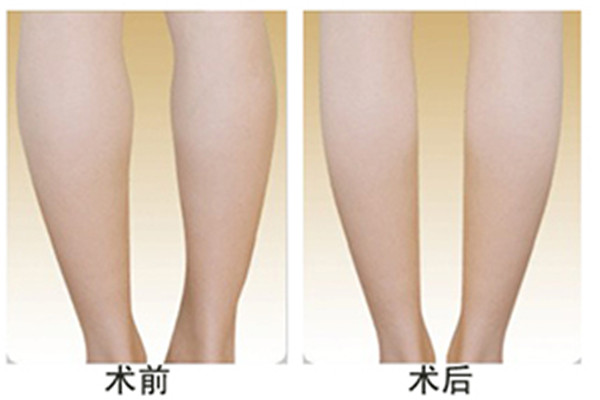 夏天打瘦腿針有副作用嗎 夏天打瘦腿針好嗎 夏天打瘦腿針有副作用嗎 夏天打瘦腿針好嗎