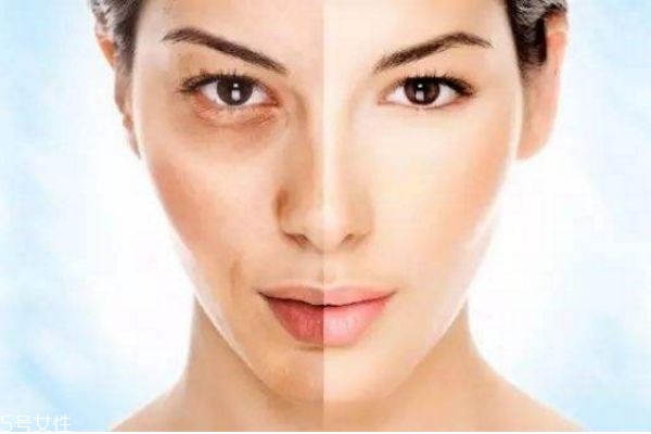 果酸換膚的原理 果酸換膚的優(yōu)缺點(diǎn) 果酸換膚的原理 果酸換膚的優(yōu)缺點(diǎn)