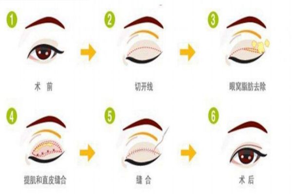 夏天適不適合割雙眼皮 什么時候是割雙眼皮最佳時間 夏天適不適合割雙眼皮 什么時候是割雙眼皮最佳時間