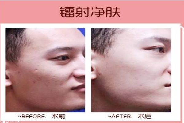 什么是鐳射凈膚呢 鐳射凈膚多少錢(qián)一次呢 什么是鐳射凈膚呢 鐳射凈膚多少錢(qián)一次呢