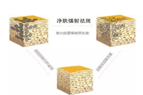 什么是鐳射凈膚呢 鐳射凈膚多少錢(qián)一次呢 什么是鐳射凈膚呢 鐳射凈膚多少錢(qián)一次呢