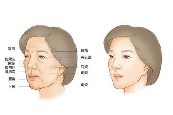 自體脂肪填充是什么呢 自體脂肪手術后有什么危害呢