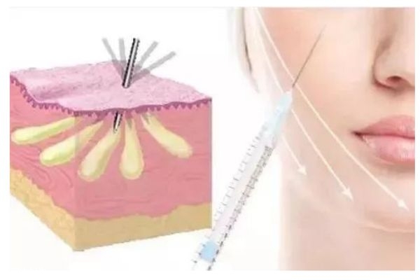 自體脂肪填充是什么呢 自體脂肪手術后有什么危害呢