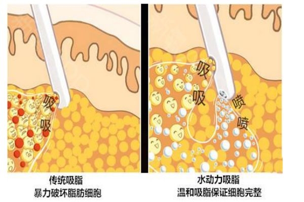 什么是水動力吸脂呢 水動力吸脂有什么用呢