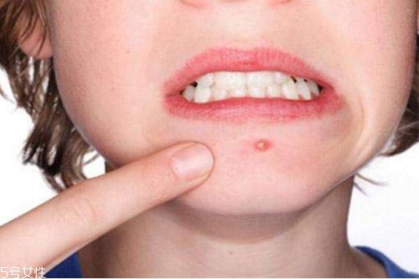 下巴上長(zhǎng)痘痘是什么原因 下巴長(zhǎng)痘痘怎么快速去除 下巴上長(zhǎng)痘痘是什么原因 下巴長(zhǎng)痘痘怎么快速去除