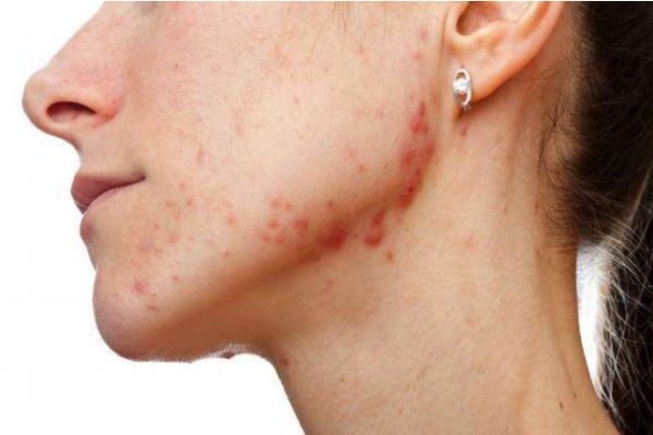 下巴上長(zhǎng)痘痘是什么原因 下巴長(zhǎng)痘痘怎么快速去除 下巴上長(zhǎng)痘痘是什么原因 下巴長(zhǎng)痘痘怎么快速去除