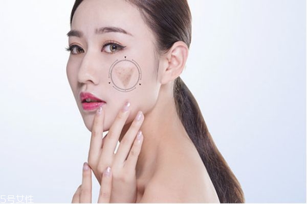 如何淡化黑色素沉著 快速淡化色素沉著 如何淡化黑色素沉著 快速淡化色素沉著