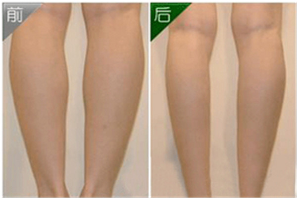 瘦腿針打幾次才會(huì)定型 瘦腿針會(huì)不會(huì)反彈 瘦腿針打幾次才會(huì)定型 瘦腿針會(huì)不會(huì)反彈