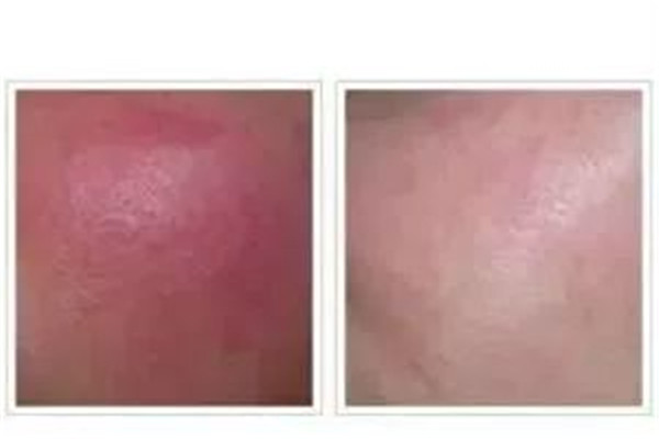 紅血絲怎么消除 紅血絲消除小偏方 紅血絲怎么消除 紅血絲消除小偏方