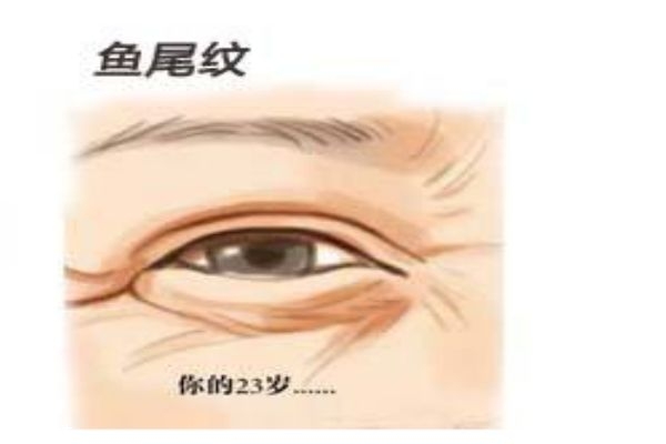 為什么會(huì)長(zhǎng)魚尾紋呢 怎么樣可以消除魚尾紋呢