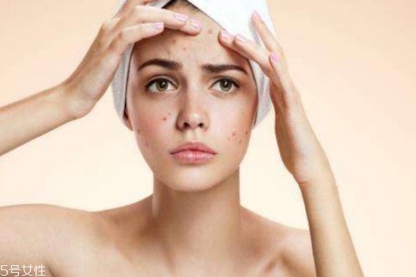 夏天容易上火長痘怎么辦 夏天上火臉上長痘這樣做 夏天容易上火長痘怎么辦 夏天上火臉上長痘這樣做