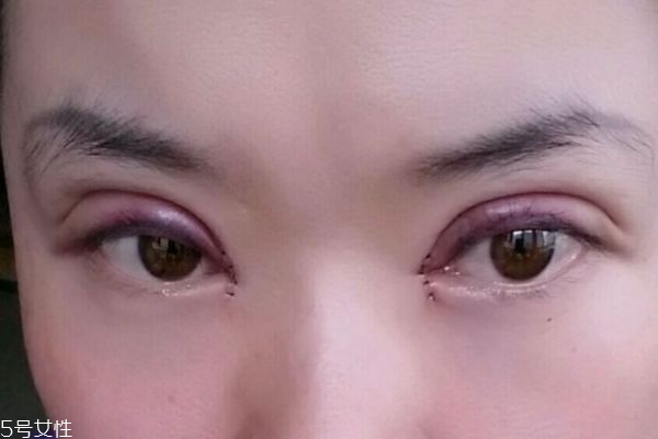 內(nèi)雙割雙眼皮容易嗎 割雙眼皮有什么注意的呢 內(nèi)雙割雙眼皮容易嗎 割雙眼皮有什么注意的呢