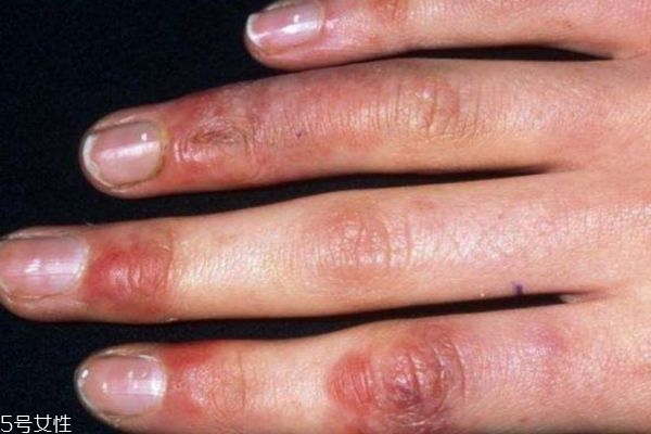 手上出現(xiàn)凍瘡應(yīng)該怎么辦呢 什么原因造成的凍瘡呢 手上出現(xiàn)凍瘡應(yīng)該怎么辦呢 什么原因造成的凍瘡呢