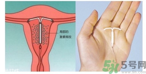 上環(huán)是什么意思？上環(huán)后注意事項(xiàng)有哪些？