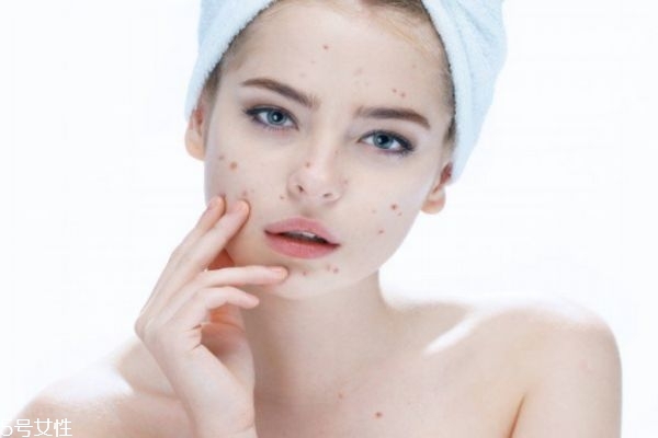 油性皮膚會干嗎 為什么有什么皮膚油有時候皮膚干呢 油性皮膚會干嗎 為什么有什么皮膚油有時候皮膚干呢