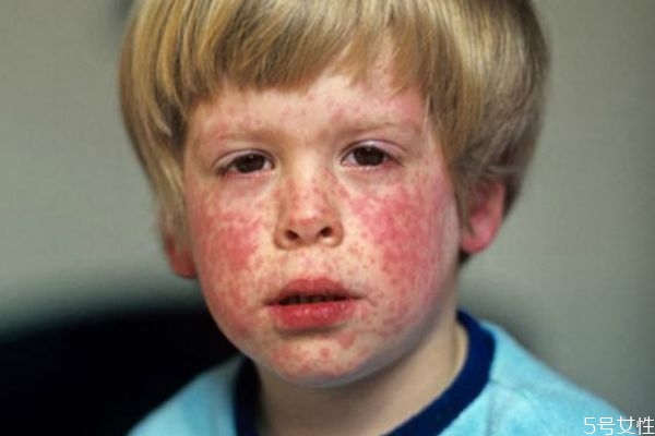 風(fēng)疹是什么途徑傳染的呢 為什么會(huì)患上風(fēng)疹呢 風(fēng)疹是什么途徑傳染的呢 為什么會(huì)患上風(fēng)疹呢