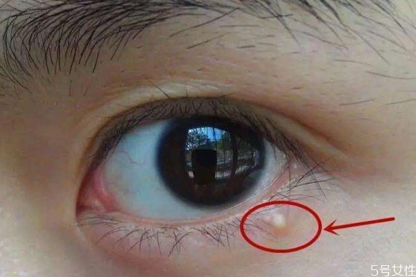 為什么涂眼霜會(huì)長(zhǎng)脂肪粒呢 什么是脂肪粒呢