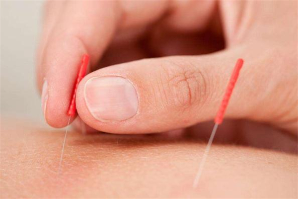 針灸減肥價(jià)格是多少 針灸減肥會(huì)反彈嗎 針灸減肥價(jià)格是多少 針灸減肥會(huì)反彈嗎