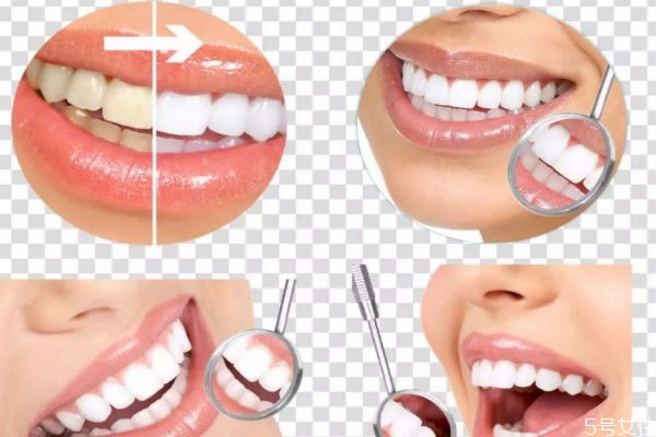 牙齒應該怎么美白呢 美白牙齒要什么方法呢 牙齒應該怎么美白呢 美白牙齒要什么方法呢