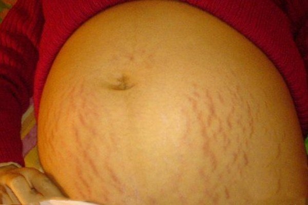 妊娠紋會(huì)長(zhǎng)在脖子上嗎 為什么會(huì)形成妊娠紋