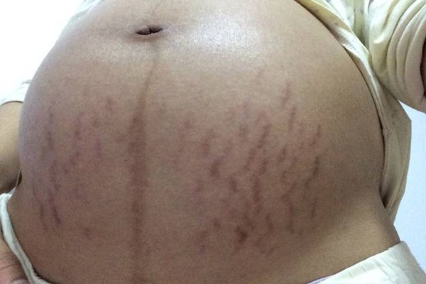 妊娠紋會(huì)長(zhǎng)在脖子上嗎 為什么會(huì)形成妊娠紋