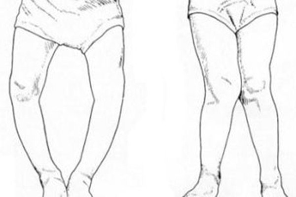 為什么會(huì)導(dǎo)致佝僂病 佝僂病前期癥狀有哪些 為什么會(huì)導(dǎo)致佝僂病 佝僂病前期癥狀有哪些