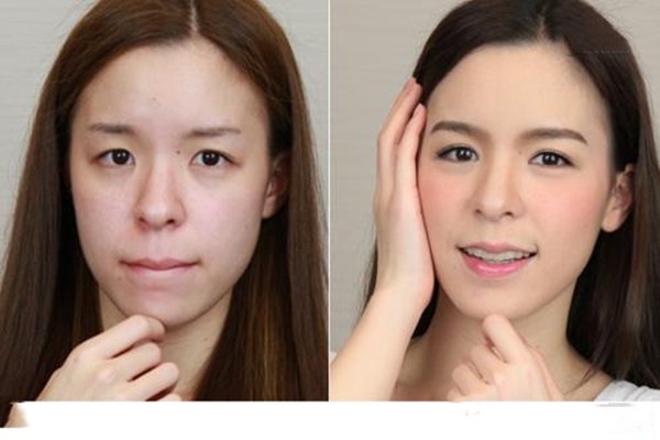 做雙眼皮重瞼術(shù)有什么危害 重瞼術(shù)有哪些治療方法 做雙眼皮重瞼術(shù)有什么危害 重瞼術(shù)有哪些治療方法