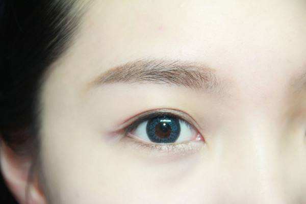 重瞼修復術(shù)是什么 重瞼修復術(shù)術(shù)前要準備什么 重瞼修復術(shù)是什么 重瞼修復術(shù)術(shù)前要準備什么