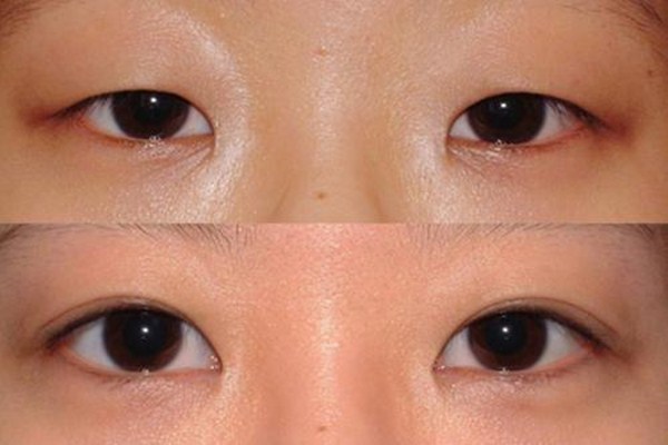 重瞼修復術(shù)是什么 重瞼修復術(shù)術(shù)前要準備什么 重瞼修復術(shù)是什么 重瞼修復術(shù)術(shù)前要準備什么