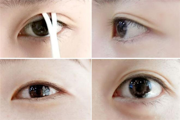 雙眼皮定型霜管用嗎 雙眼皮定型霜和雙眼皮貼哪個(gè)好