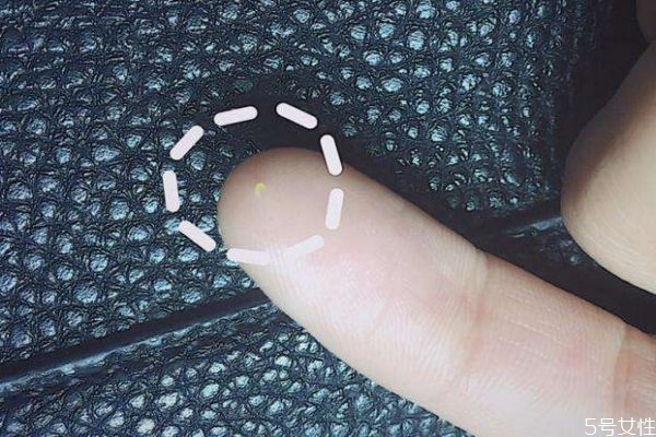 如何預防脂肪粒呢 預防脂肪粒的辦法有什么呢