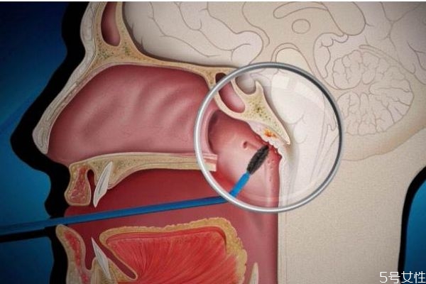 什么是鼻咽癌呢 鼻咽癌有什么危害呢 什么是鼻咽癌呢 鼻咽癌有什么危害呢