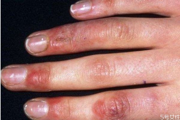 凍瘡是怎么造成的呢 為什么會(huì)有凍瘡呢