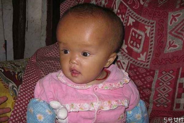 什么是腦積水呢 腦積水有什么危害呢 什么是腦積水呢 腦積水有什么危害呢