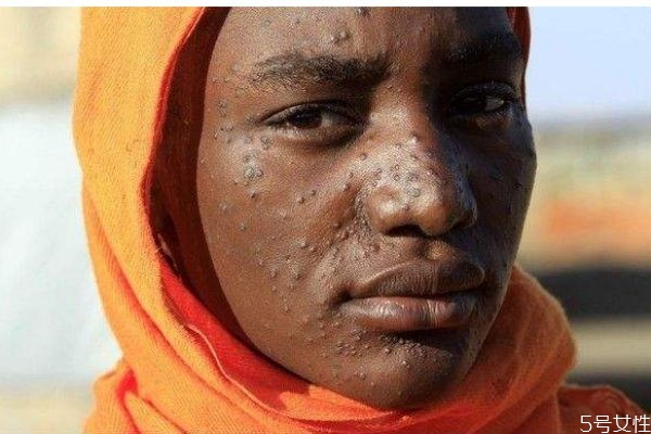 什么是黑熱病呢 黑熱病有什么危害呢 什么是黑熱病呢 黑熱病有什么危害呢