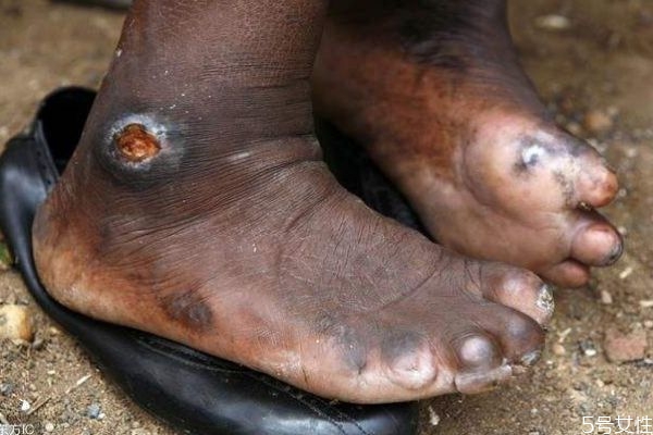 什么是麻風病呢 麻風病有實名癥狀呢