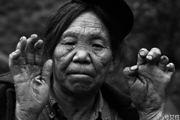 麻風病是怎么造成的呢 造成麻風病的原因有什么呢