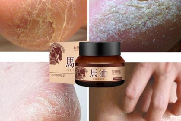 季節(jié)性手脫皮是怎么造成的呢 如何治療季節(jié)性手脫皮呢 季節(jié)性手脫皮是怎么造成的呢 如何治療季節(jié)性手脫皮呢